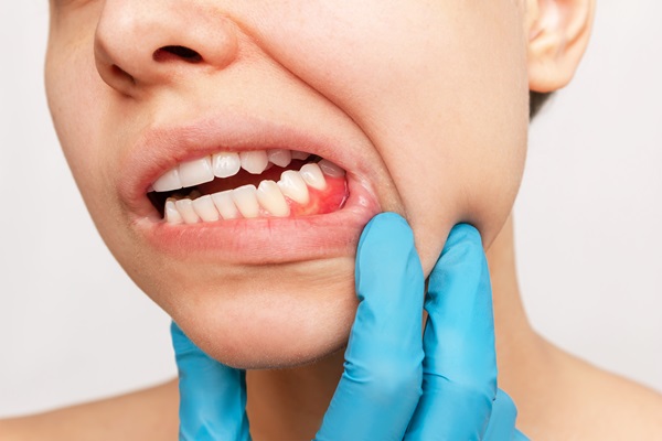 Important FAQs About Gum Disease