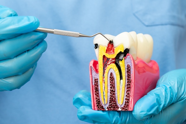 Why Root Canals Are Not As Scary As People Think